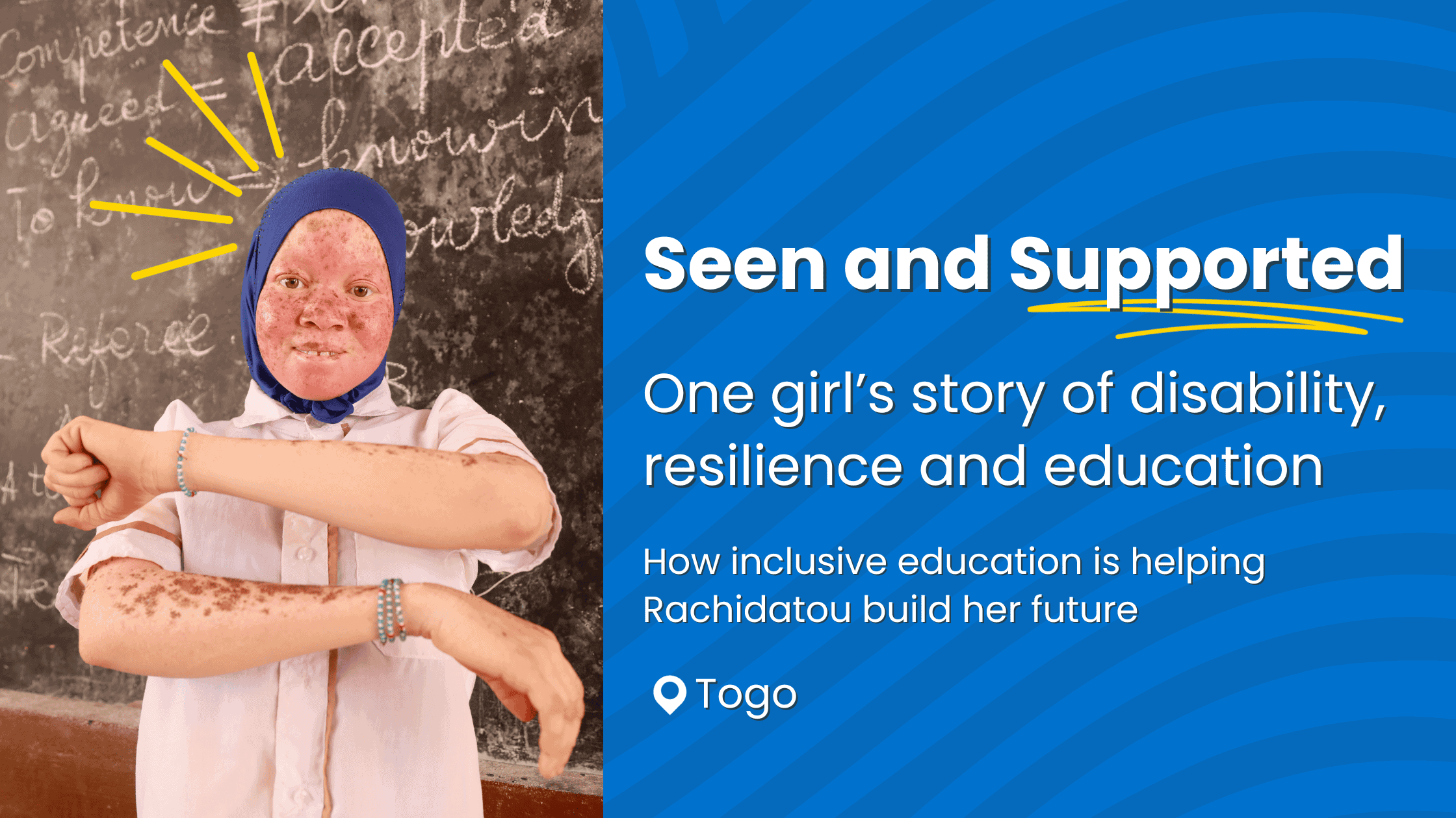 Blog-Banner-Disability-Pride-Month-Rwanda-Albinism image